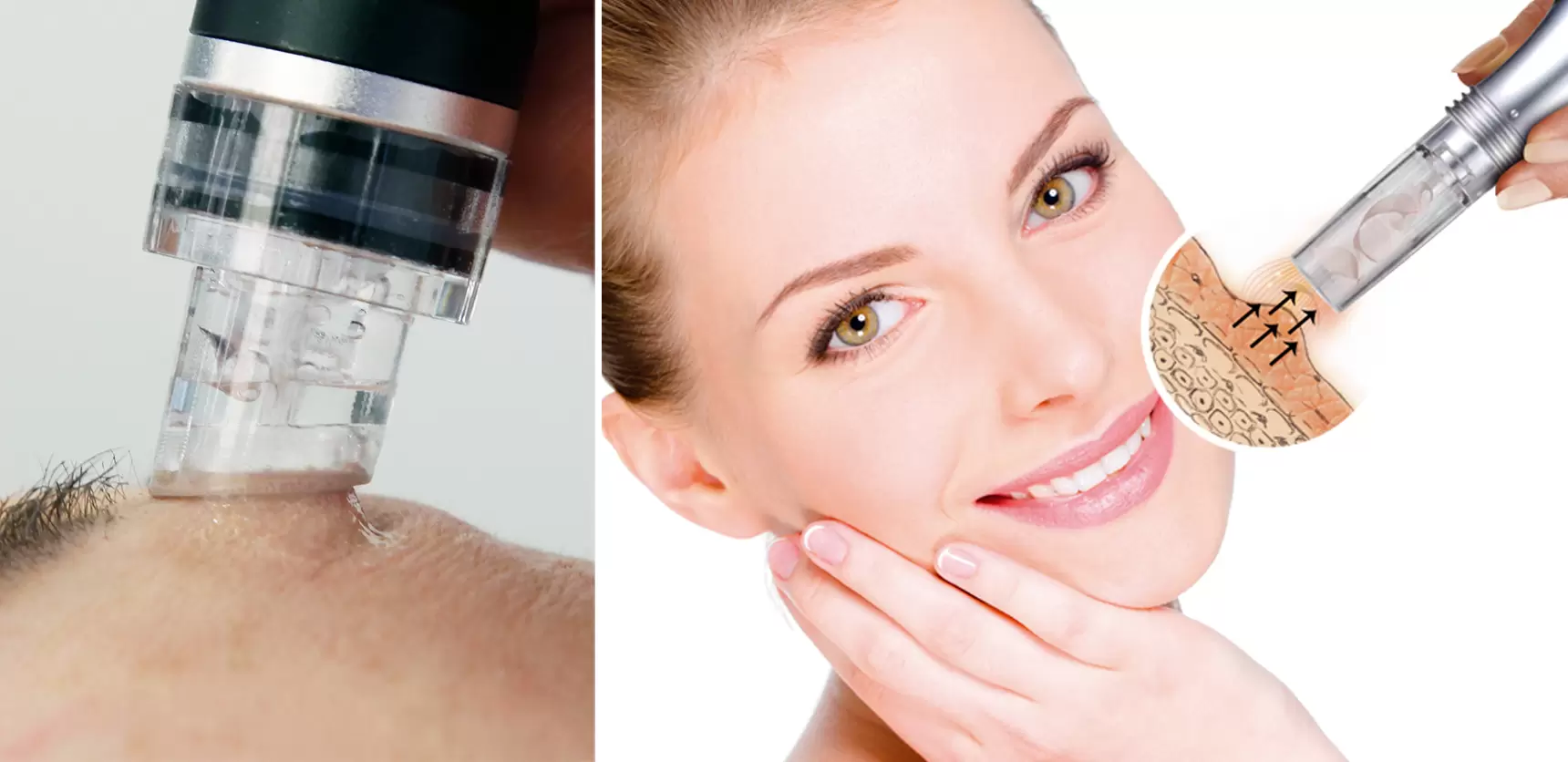 Aquabration – Sanftes Hautschälen